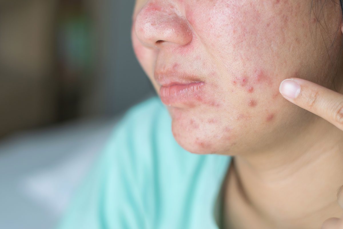 Tretinoin for Acne